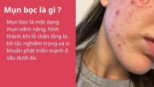Mụn bọc: Dấu hiệu nhận biết, nguyên nhân gây mụn và cách xử lý đúng cách