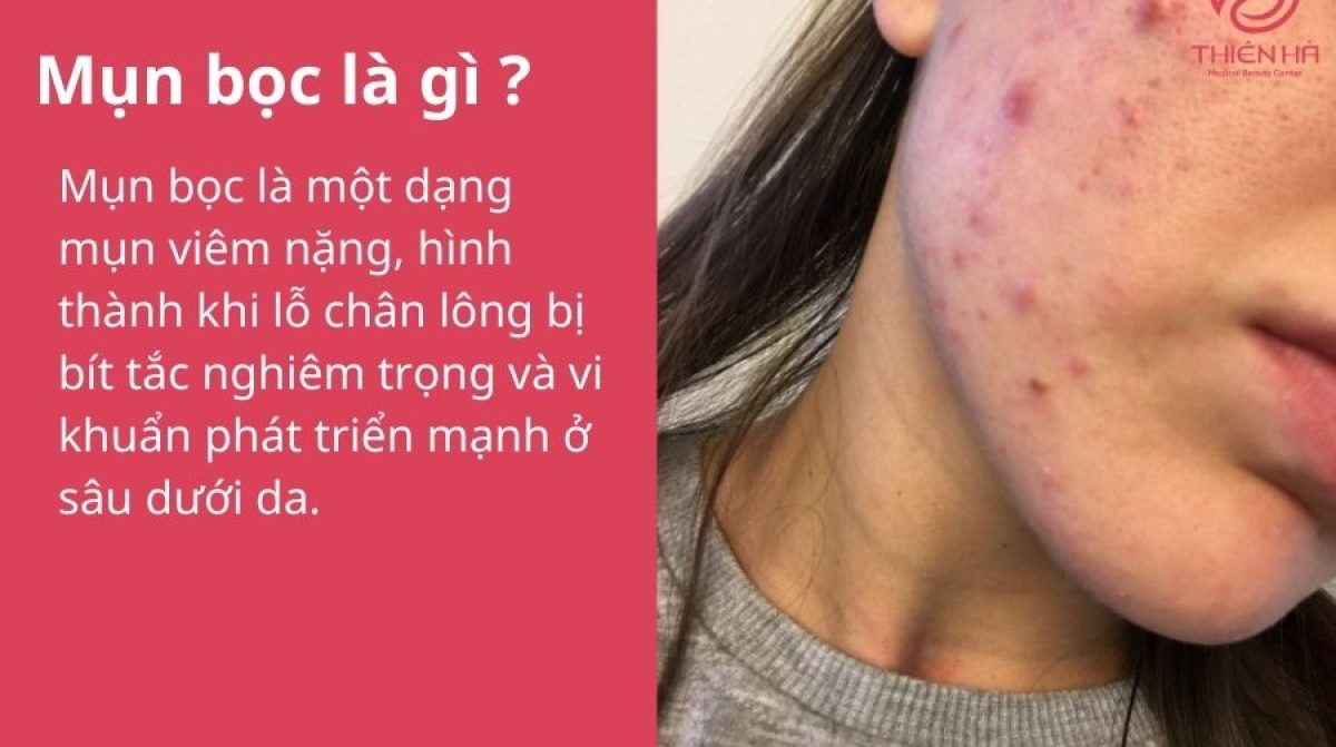 Mụn bọc: Dấu hiệu nhận biết, nguyên nhân gây mụn và cách xử lý đúng cách