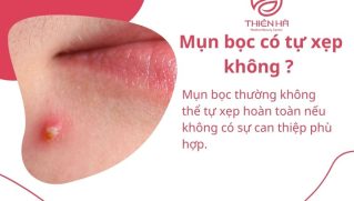 Mụn bọc có tự xẹp không? Cách xử lý đúng chuẩn y khoa để tránh sẹo