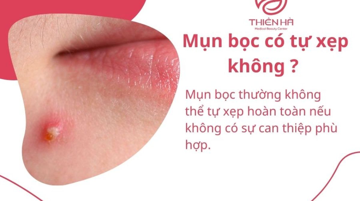 Mụn bọc có tự xẹp không? Cách xử lý đúng chuẩn y khoa để tránh sẹo