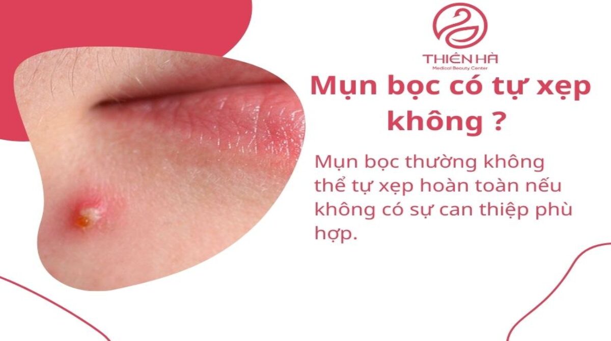 Mụn bọc có tự xẹp không? Cách xử lý đúng chuẩn y khoa để tránh sẹo