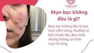 Mụn bọc không đầu là gì? Nguyên nhân hình thành và cách điều trị hiệu quả