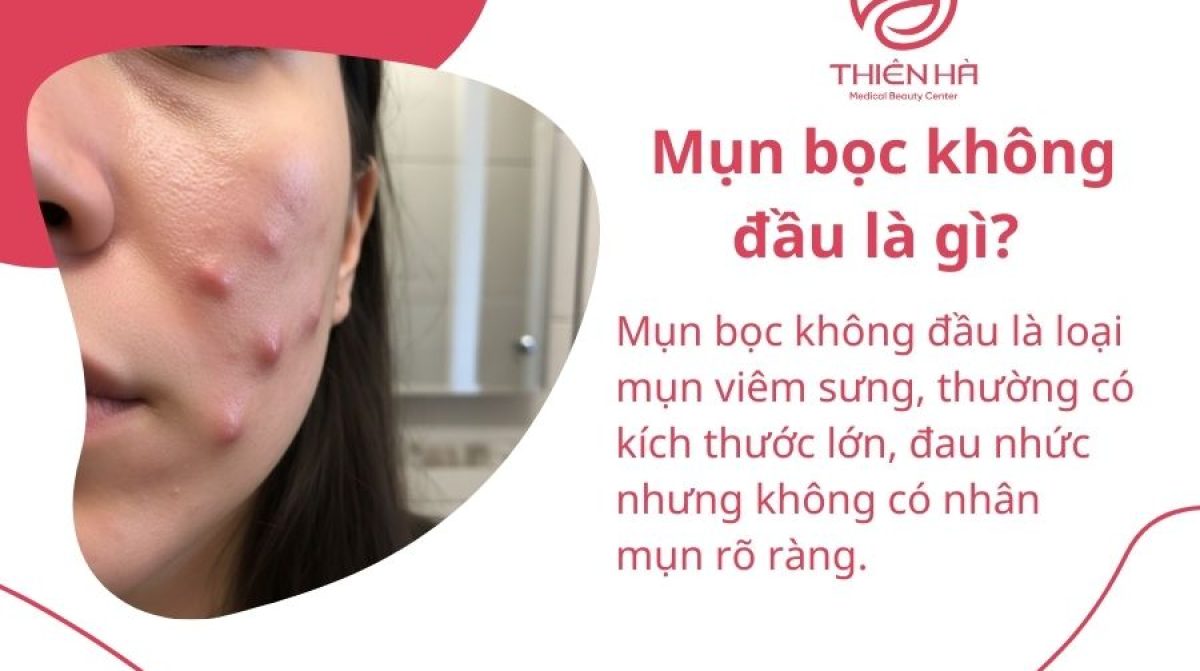 Mụn bọc không đầu là gì? Nguyên nhân hình thành và cách điều trị hiệu quả