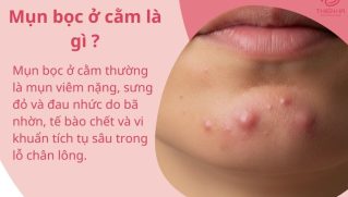 Mụn bọc ở cằm: Nguyên nhân, dấu hiệu và cách xử lý an toàn tránh sẹo
