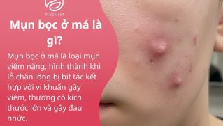 Mụn bọc ở má là gì? Cách nhận biết, điều trị và phòng ngừa tái phát