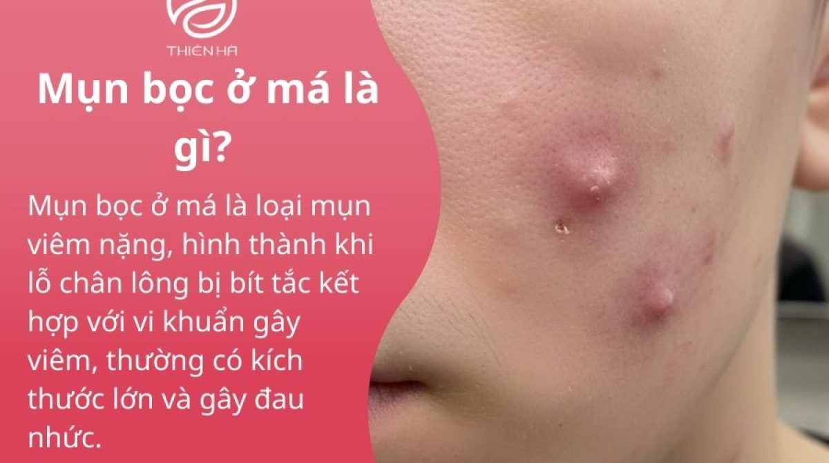 Mụn bọc ở má là gì? Cách nhận biết, điều trị và phòng ngừa tái phát