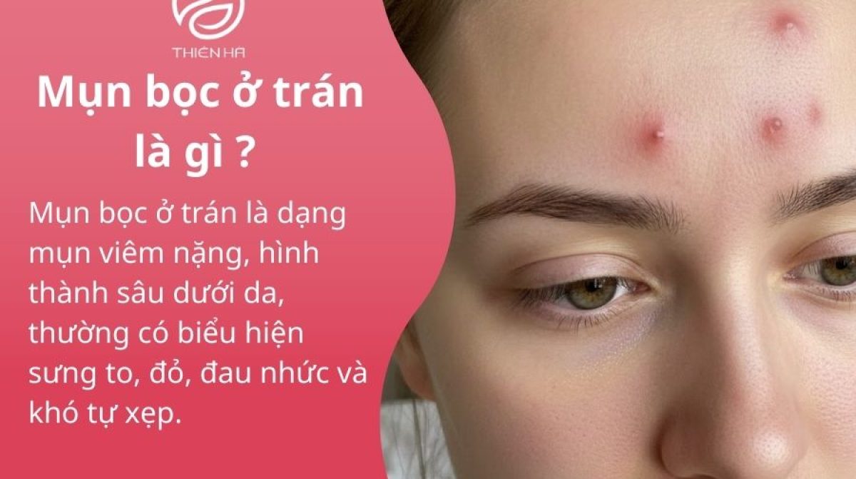 Mụn bọc ở trán: Nguyên nhân, dấu hiệu nguy hiểm và cách điều trị hiệu quả
