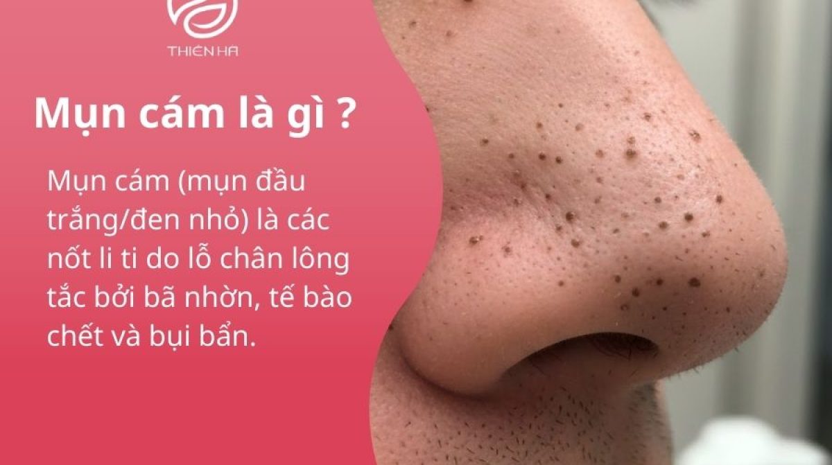 Tìm hiểu mụn cám: Dấu hiệu, nguyên nhân và phương pháp điều trị đúng cách