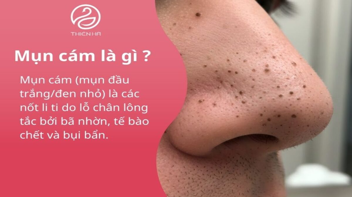 Tìm hiểu mụn cám: Dấu hiệu, nguyên nhân và phương pháp điều trị đúng cách
