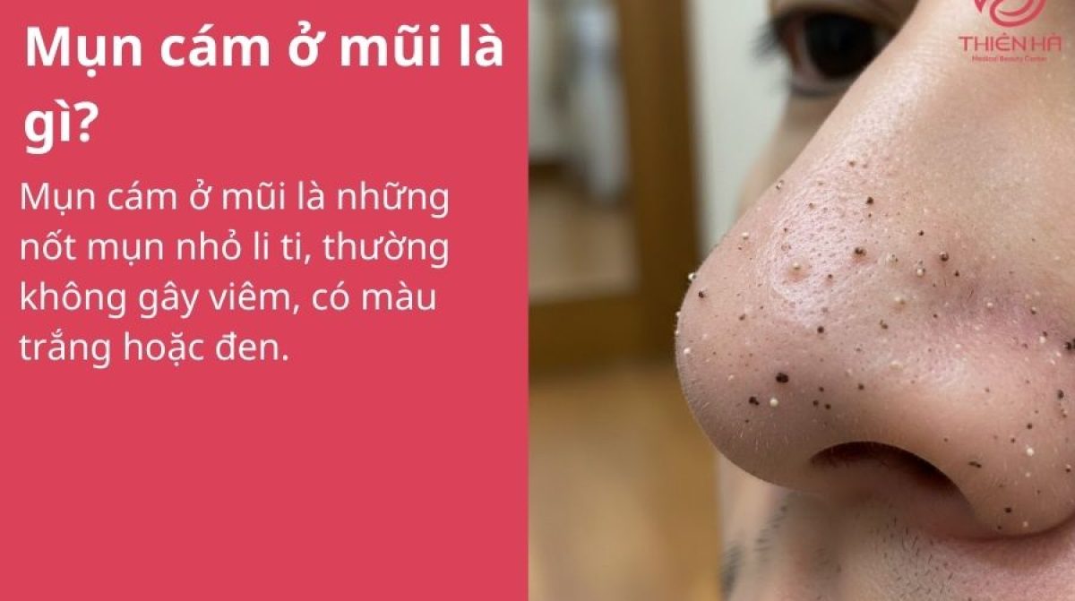 Mụn cám ở mũi là gì? Nguyên nhân và cách điều trị đúng chuẩn da liễu