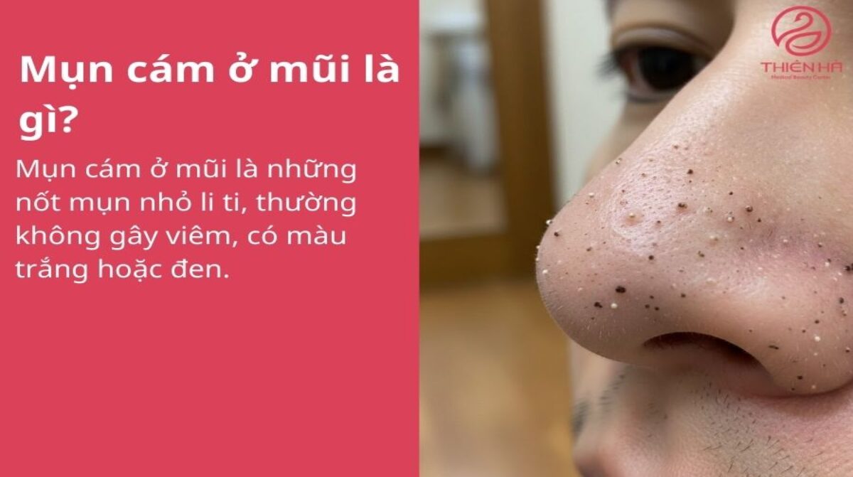 Mụn cám ở mũi là gì? Nguyên nhân và cách điều trị đúng chuẩn da liễu