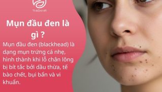 Mụn đầu đen là gì ? Nguyên nhân cách chăm sóc da và điều trị tại nhà