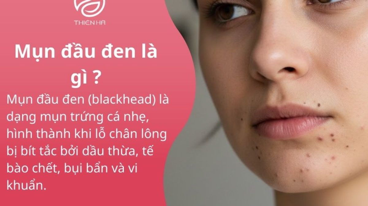 Mụn đầu đen là gì ? Nguyên nhân cách chăm sóc da và điều trị tại nhà