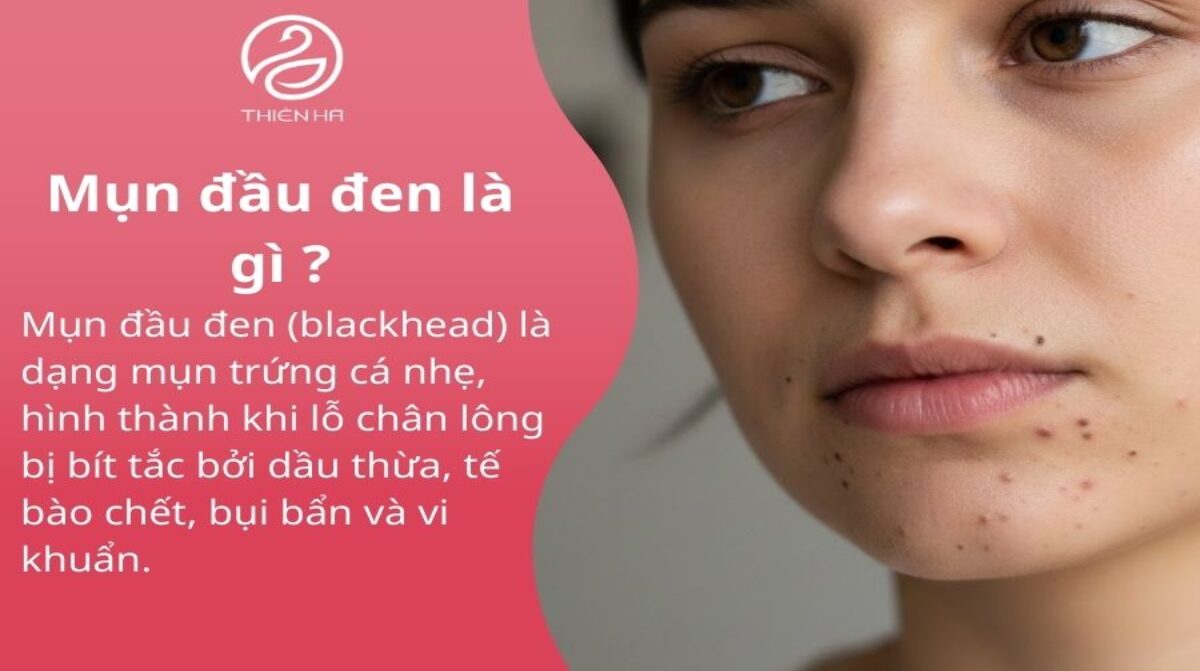 Mụn đầu đen là gì ? Nguyên nhân cách chăm sóc da và điều trị tại nhà