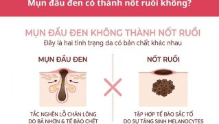 Mụn đầu đen có thành nốt ruồi không? Xem cách xử lý