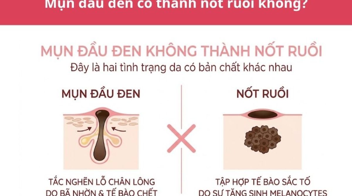 Mụn đầu đen có thành nốt ruồi không? Xem cách xử lý