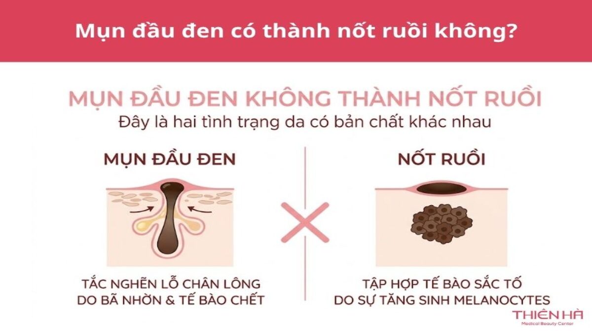 Mụn đầu đen có thành nốt ruồi không? Xem cách xử lý