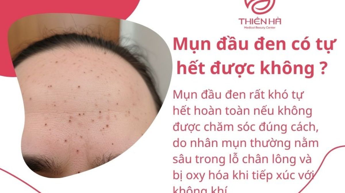 Mụn đầu đen có tự hết được không ? Cách xử lý hiệu quả
