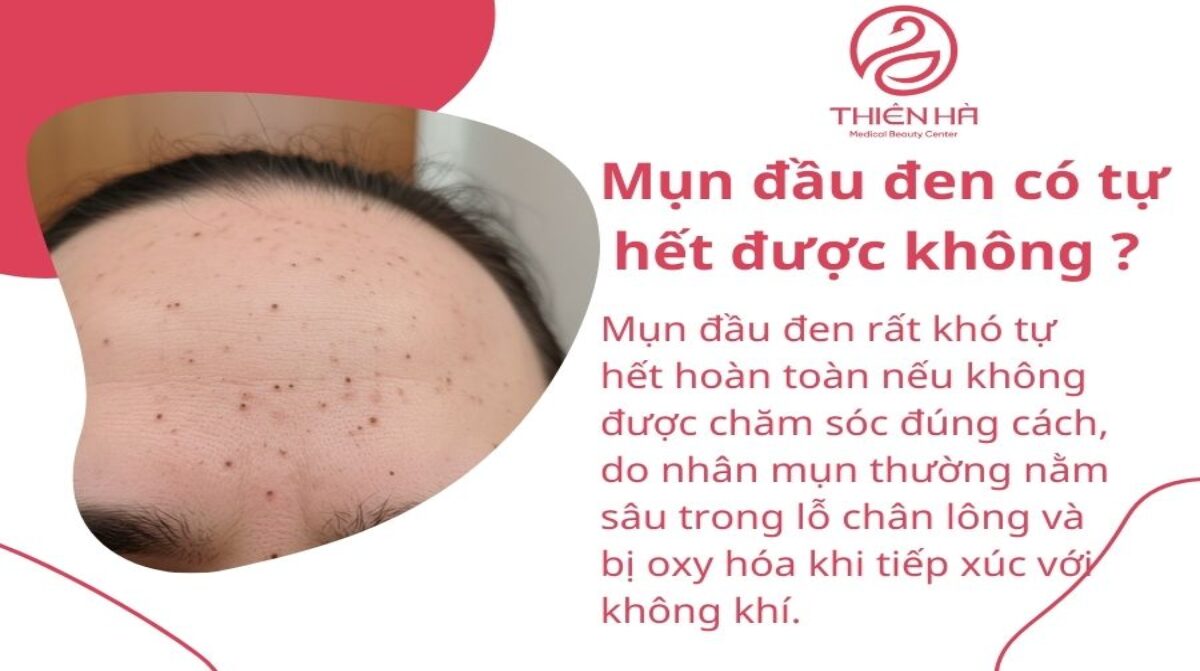 Mụn đầu đen có tự hết được không ? Cách xử lý hiệu quả