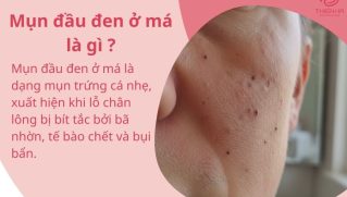 Mụn đầu đen ở má là gì? Nguyên nhân, dấu hiệu và cách điều trị đúng cách