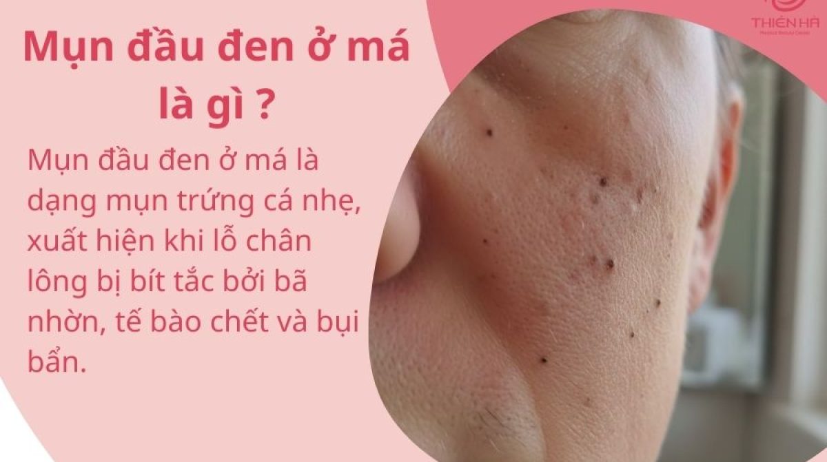 Mụn đầu đen ở má là gì? Nguyên nhân, dấu hiệu và cách điều trị đúng cách