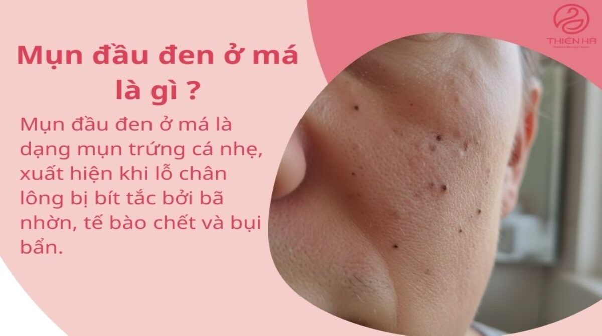 Mụn đầu đen ở má là gì? Nguyên nhân, dấu hiệu và cách điều trị đúng cách