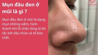 Mụn đầu đen ở mũi: Nguyên nhân và cách điều trị hiệu quả tại nhà
