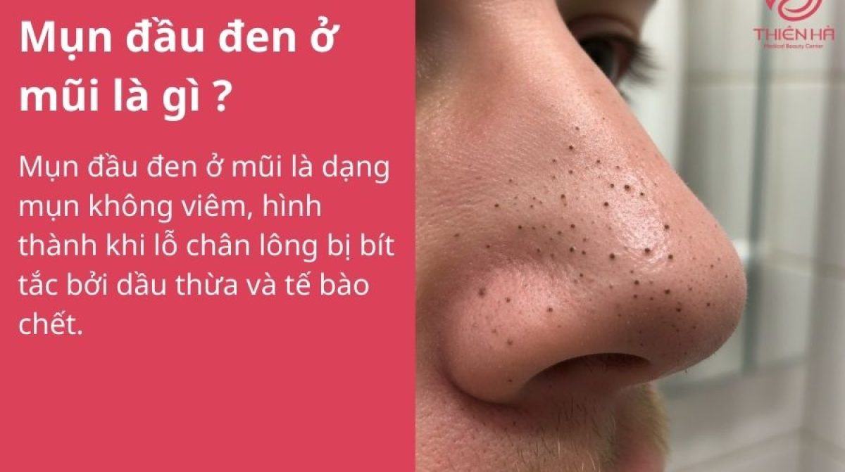 Mụn đầu đen ở mũi: Nguyên nhân và cách điều trị hiệu quả tại nhà