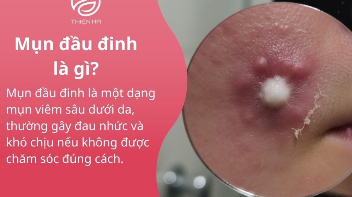 Mụn đầu đinh là gì? Dấu hiệu, nguyên nhân và cách trị hiệu quả