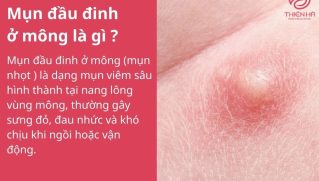 Mụn đầu đinh ở mông: Nhận biết, xử lý sớm để tránh biến chứng