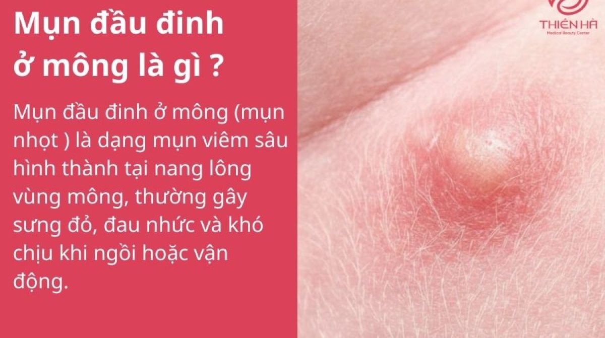 Mụn đầu đinh ở mông: Nhận biết, xử lý sớm để tránh biến chứng