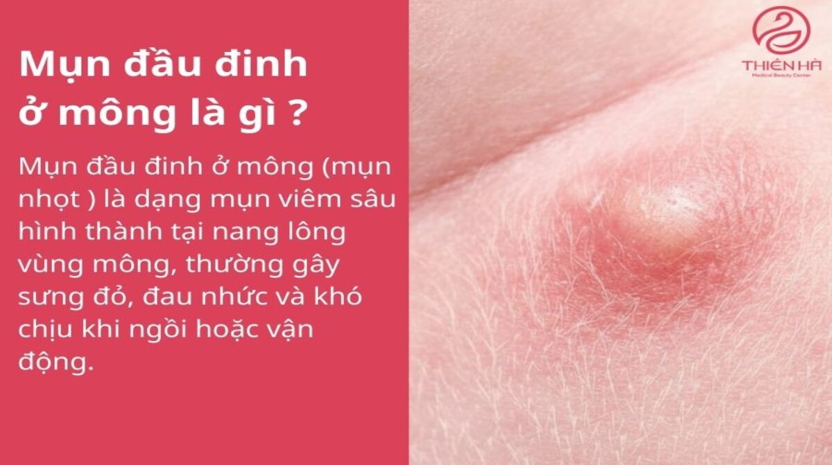 Mụn đầu đinh ở mông: Nhận biết, xử lý sớm để tránh biến chứng