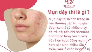 Mụn dậy thì: Nguyên nhân, cách chăm sóc và điều trị hiệu quả