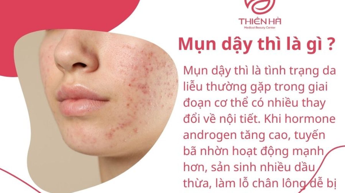 Mụn dậy thì: Nguyên nhân, cách chăm sóc và điều trị hiệu quả