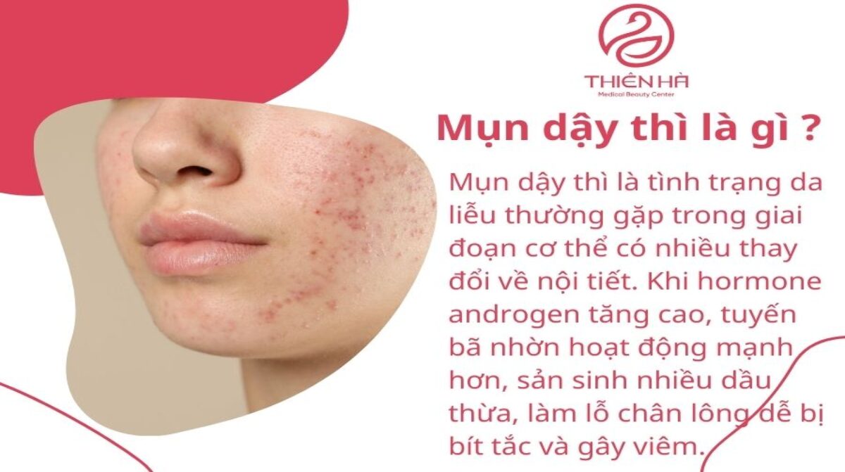 Mụn dậy thì: Nguyên nhân, cách chăm sóc và điều trị hiệu quả