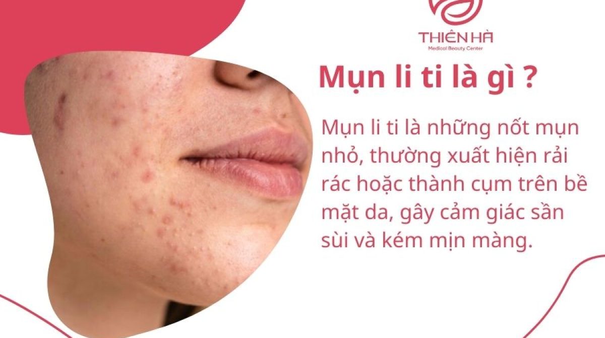 Mụn li ti trên mặt: Dấu hiệu, nguyên nhân và hướng điều trị chuẩn y khoa