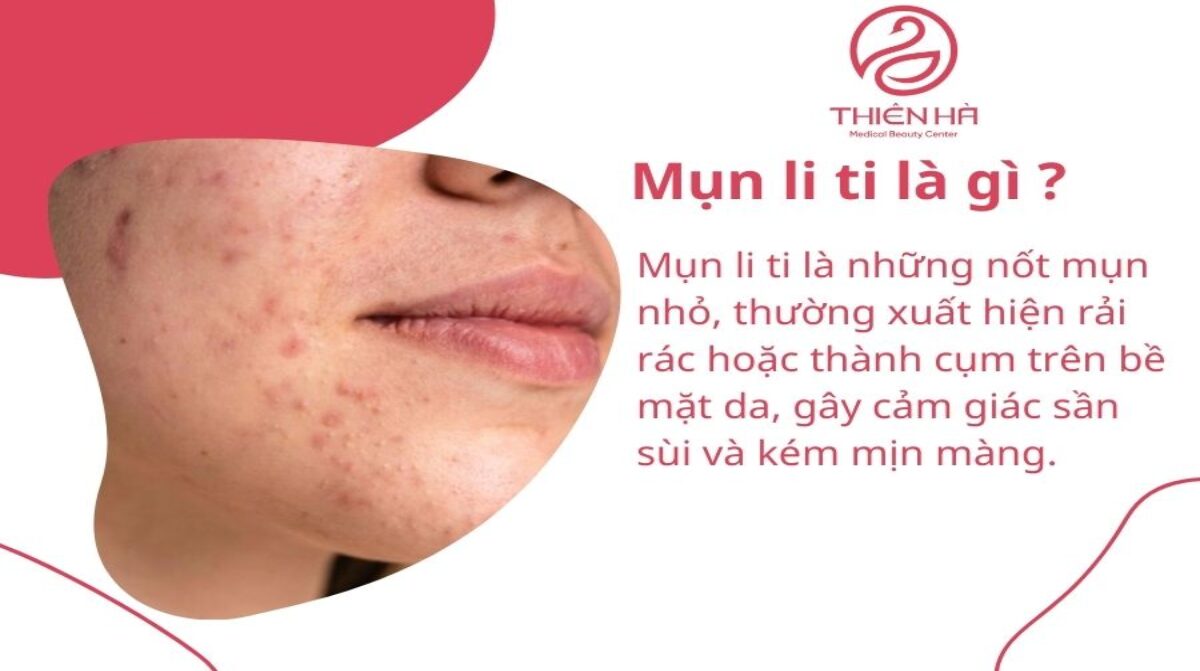 Mụn li ti trên mặt: Dấu hiệu, nguyên nhân và hướng điều trị chuẩn y khoa
