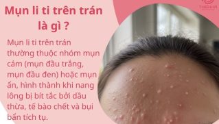Mụn li ti trên trán và cách điều trị giúp da mịn màng, giảm tái phát