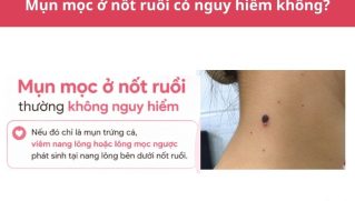 Mụn mọc ở nốt ruồi có nguy hiểm không? Nguyên nhân và cách xử lý