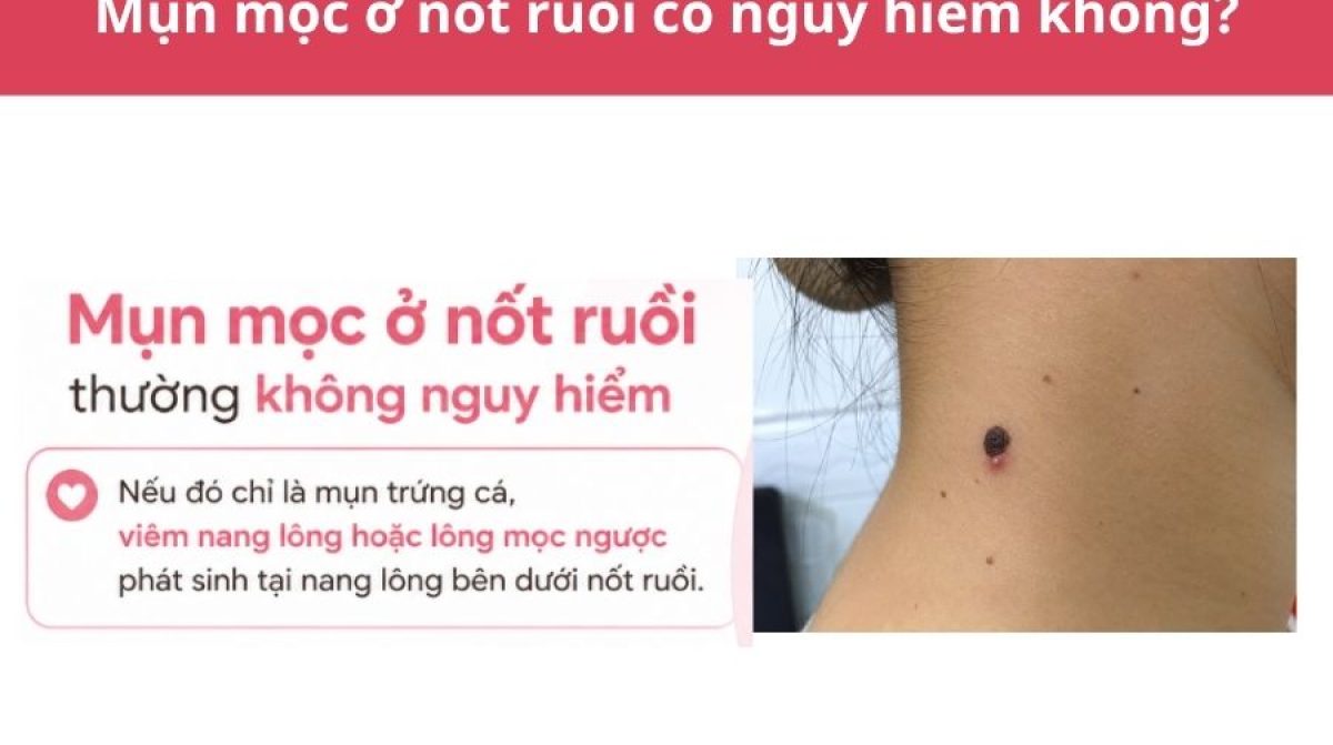 Mụn mọc ở nốt ruồi có nguy hiểm không? Nguyên nhân và cách xử lý