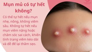 Mụn mủ có tự hết không? Bác sĩ da liễu giải đáp chi tiết
