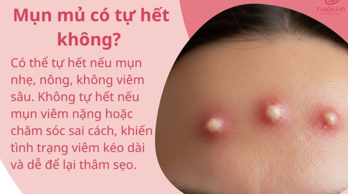Mụn mủ có tự hết không? Bác sĩ da liễu giải đáp chi tiết