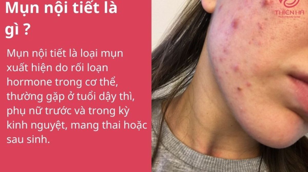 Mụn nội tiết là gì và dấu hiệu nhận biết sớm để điều trị hiệu quả