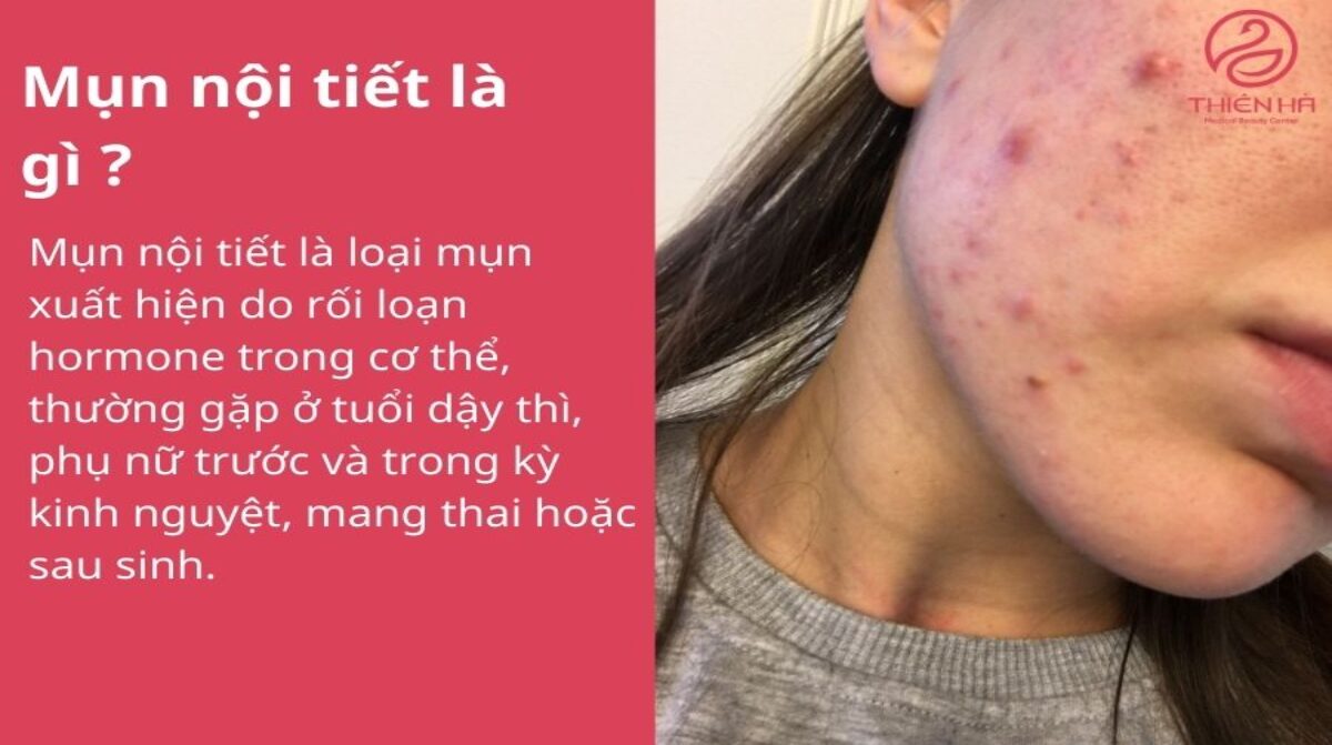 Mụn nội tiết là gì và dấu hiệu nhận biết sớm để điều trị hiệu quả