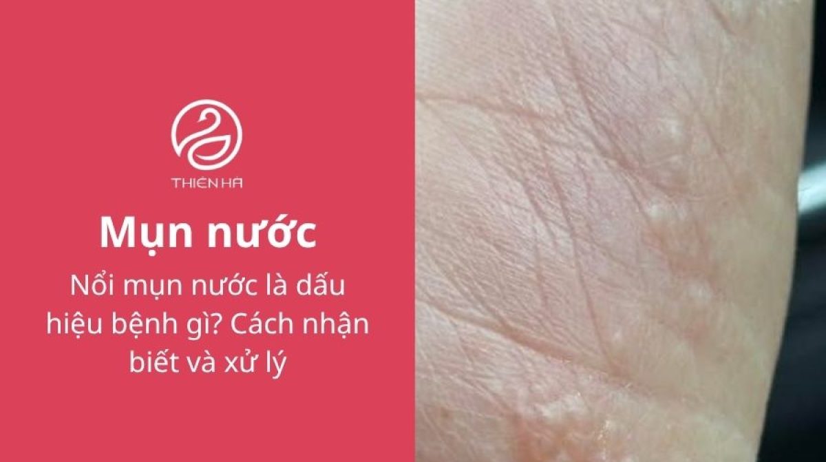 Mụn nước là gì? Nguyên nhân, dấu hiệu và cách xử lý an toàn