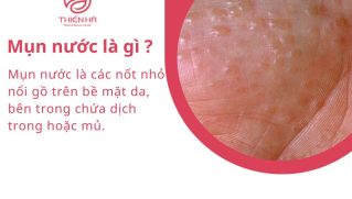 Mụn nước là gì? Nguyên nhân, dấu hiệu và cách xử lý an toàn