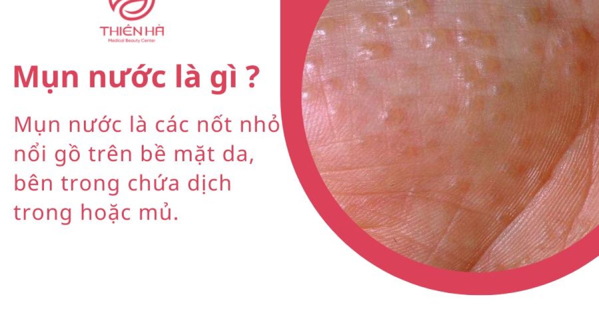 Mụn nước là gì? Nguyên nhân, dấu hiệu và cách xử lý an toàn