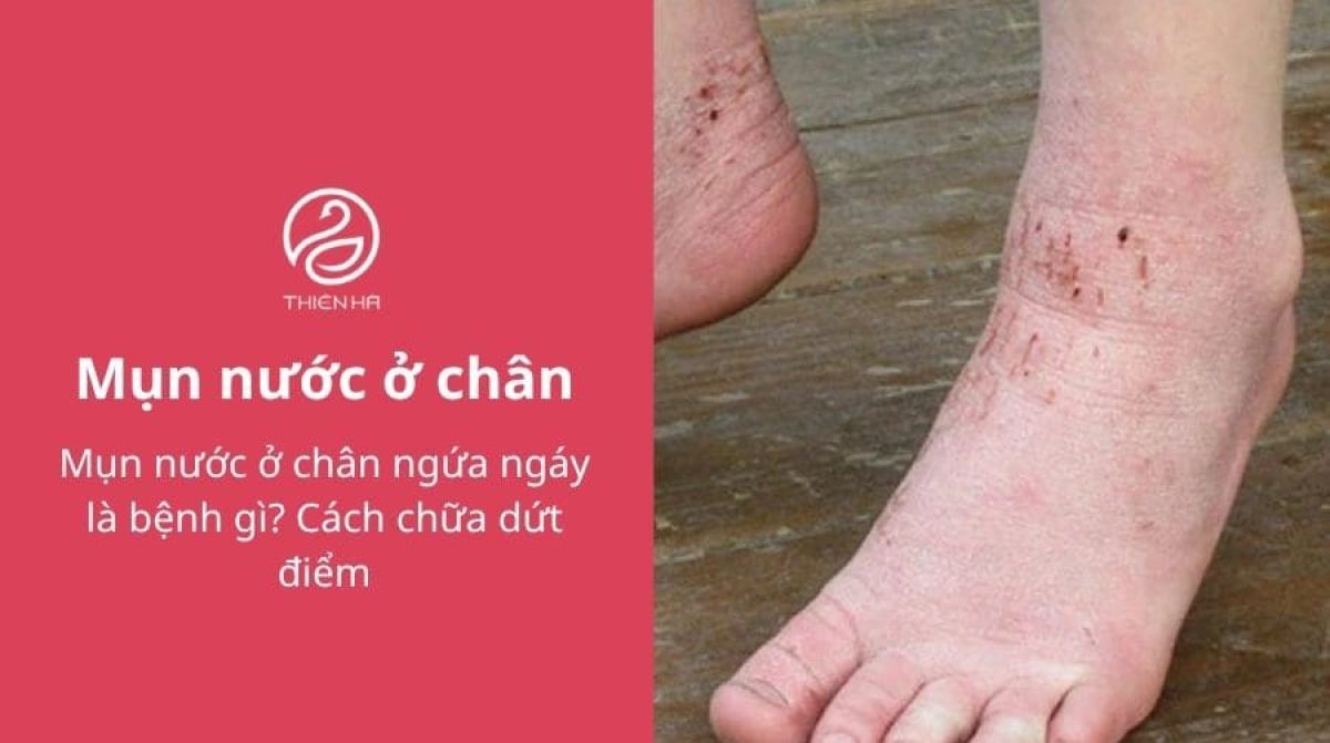 Mụn nước ở chân ngứa ngáy là bệnh gì? Cách chữa dứt điểm
