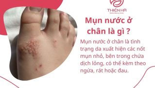Mụn nước ở chân do đâu? Nhận biết sớm và cách điều trị hiệu quả tại nhà