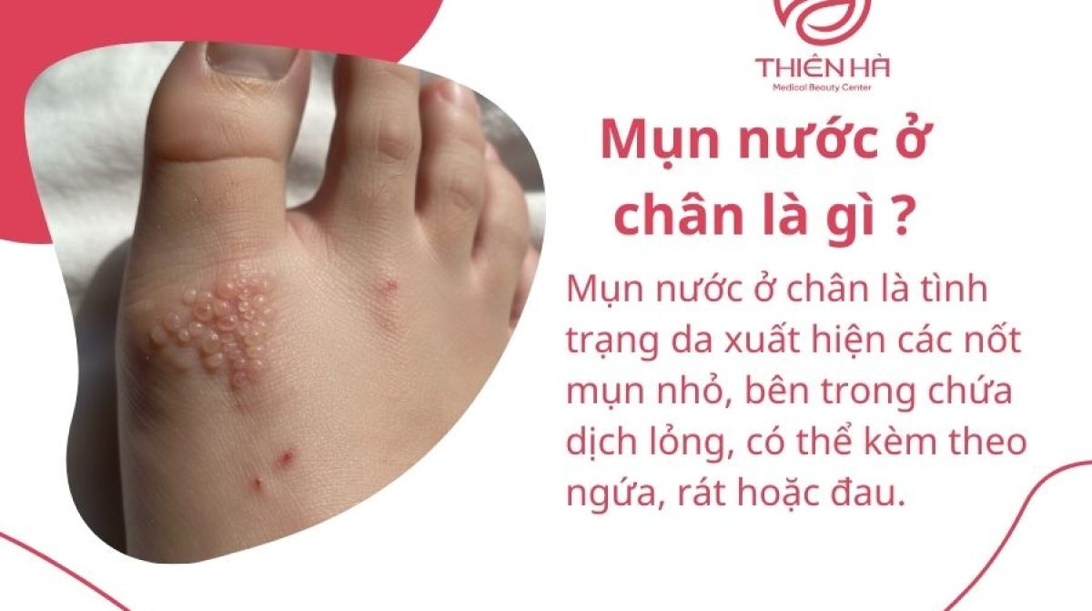 Mụn nước ở chân do đâu? Nhận biết sớm và cách điều trị hiệu quả tại nhà